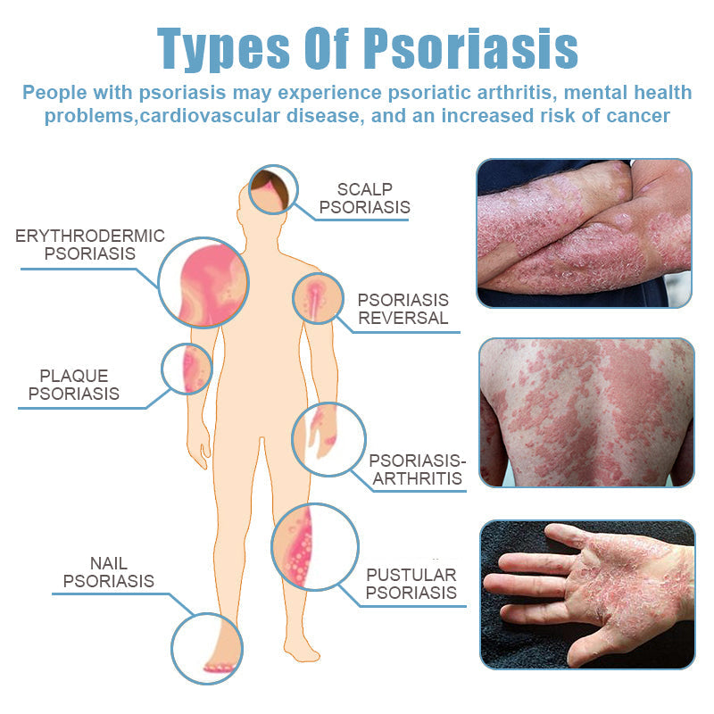 🌞Bee Venom & Ocean Natural Eczema Psoriasis Relief Cream (For all skin conditions)