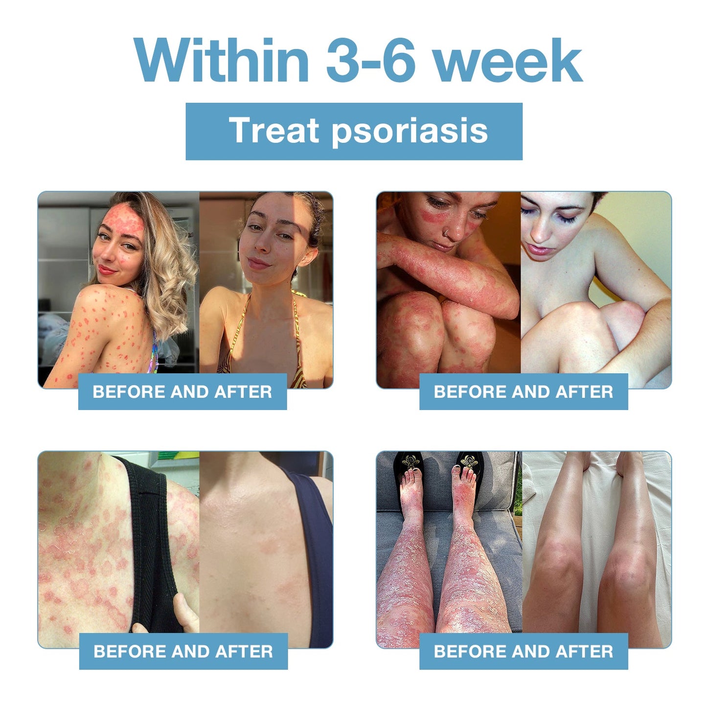 🌞Bee Venom & Ocean Natural Eczema Psoriasis Relief Cream (For all skin conditions)