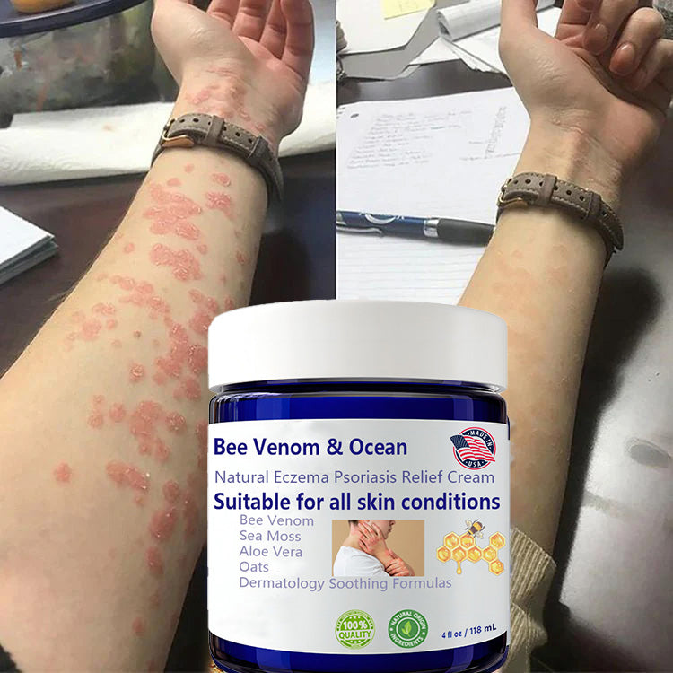 🌞Bee Venom & Ocean Natural Eczema Psoriasis Relief Cream (For all skin conditions)