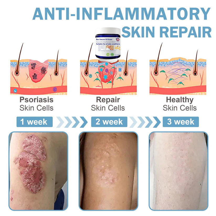 🌞Bee Venom & Ocean Natural Eczema Psoriasis Relief Cream (For all skin conditions)